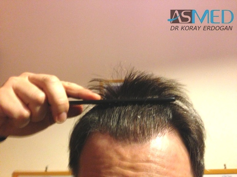 norwood4 3167-grafts-FUE-Repair file_zps4923ca9c