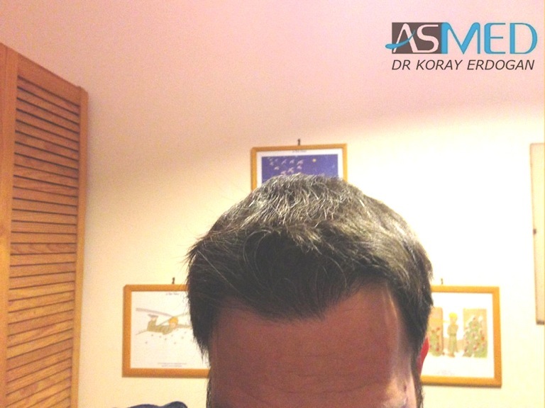 norwood4 3167-grafts-FUE-Repair file_zps5d0b4484