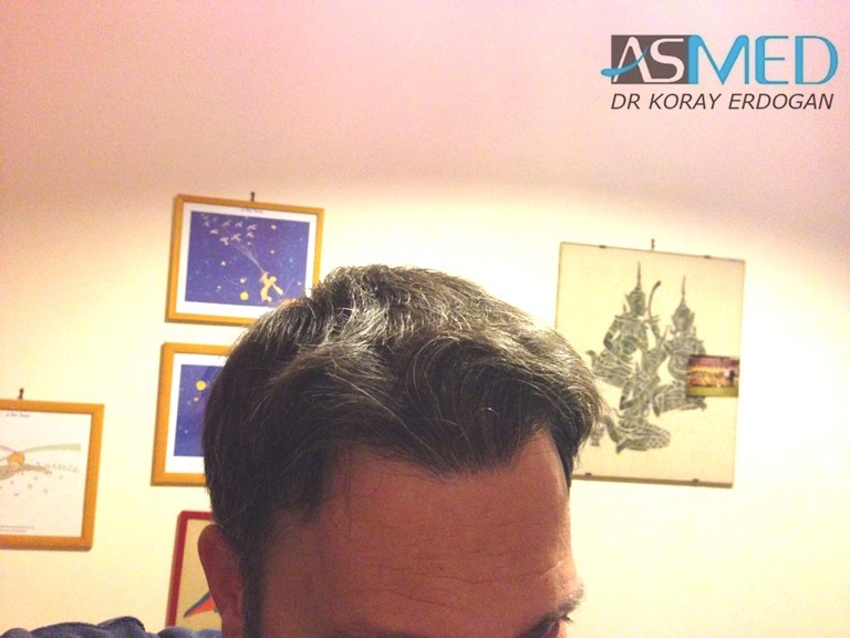 norwood4 3167-grafts-FUE-Repair file_zps7c83f890
