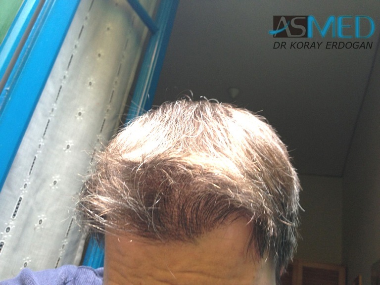 norwood4 3167-grafts-FUE-Repair file_zps89475b92