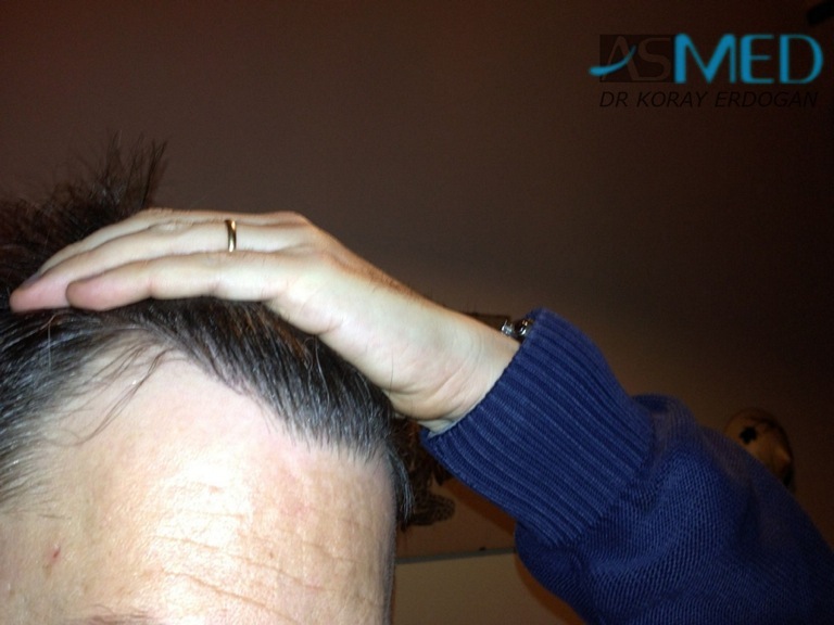 norwood4 3167-grafts-FUE-Repair file_zpsb190d5bc