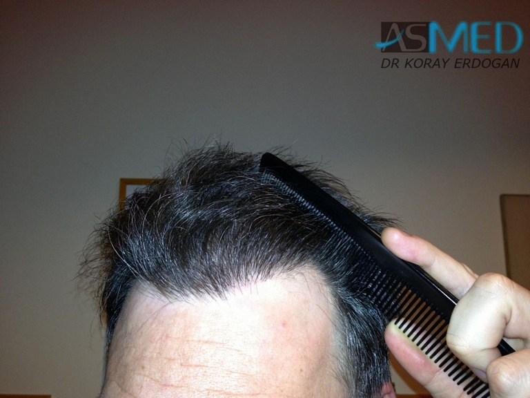 norwood4 3167-grafts-FUE-Repair file_zpsca76ef0d