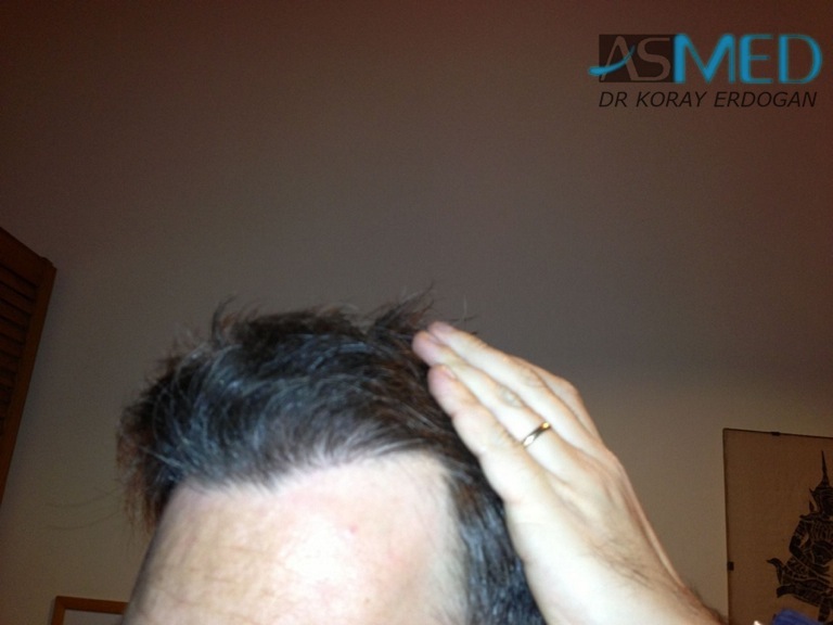 norwood4 3167-grafts-FUE-Repair file_zpsf1e56bf8