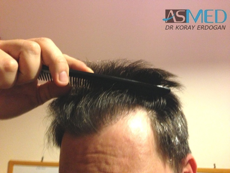 norwood4 3167-grafts-FUE-Repair file_zpsfff54674