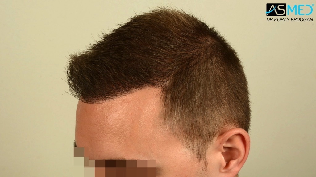 4000 Grafts Fue | Norwood 5 | Asmed Hair Transplant Results