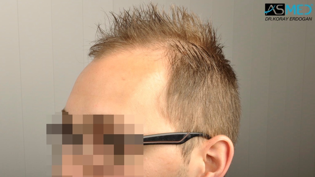 4000 Grafts Fue | Norwood 5 | Asmed Hair Transplant Results