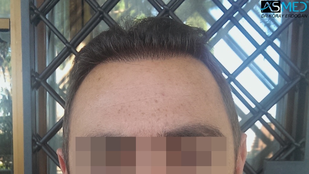norwood4 4008-grafts-FUE file_zps143b9c2a