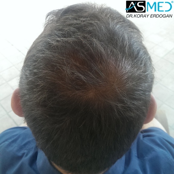 norwood4 4008-grafts-FUE file_zps2541a77f