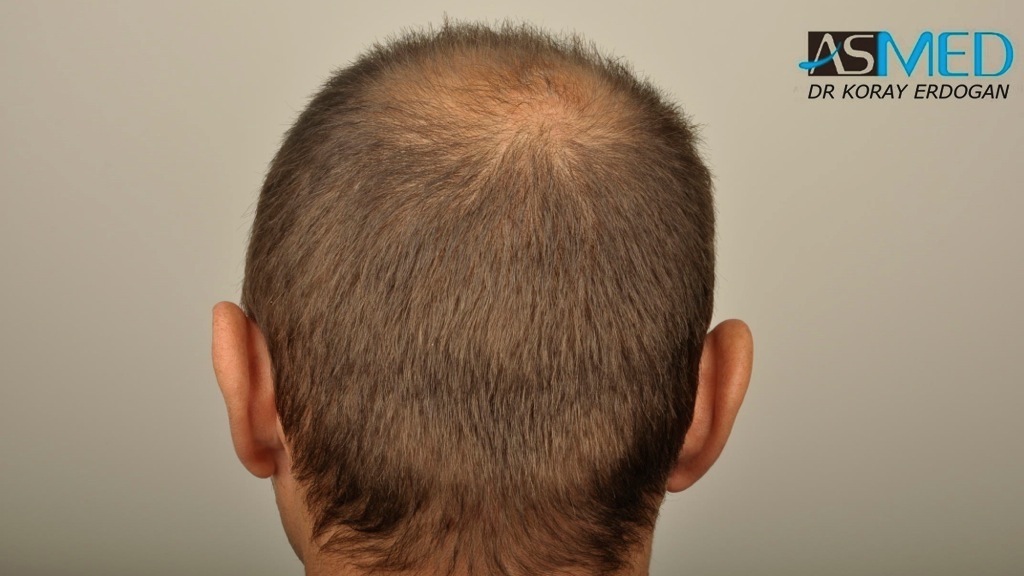 norwood4 4008-grafts-FUE file_zps36d30f06