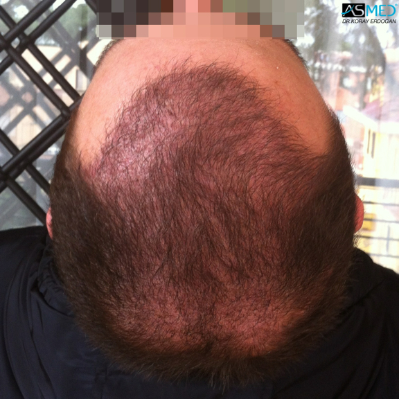 norwood4 4008-grafts-FUE file_zps3977f083