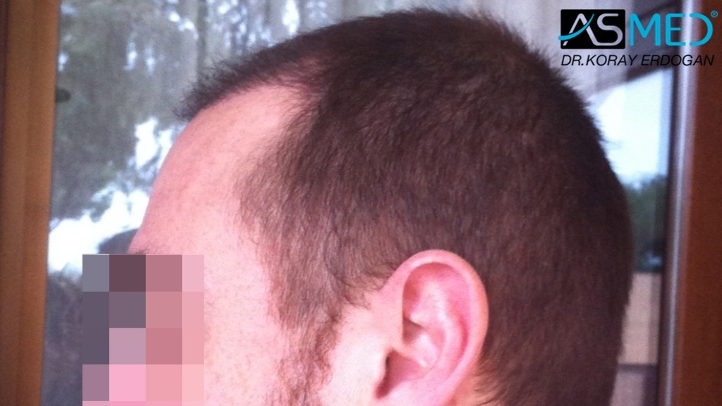 norwood4 4008-grafts-FUE file_zps3a8872ce