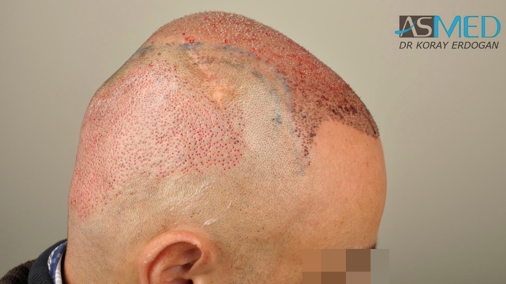 norwood4 4008-grafts-FUE file_zps5368ef1d
