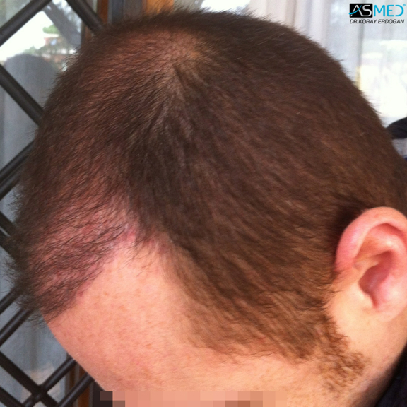 norwood4 4008-grafts-FUE file_zps59787161