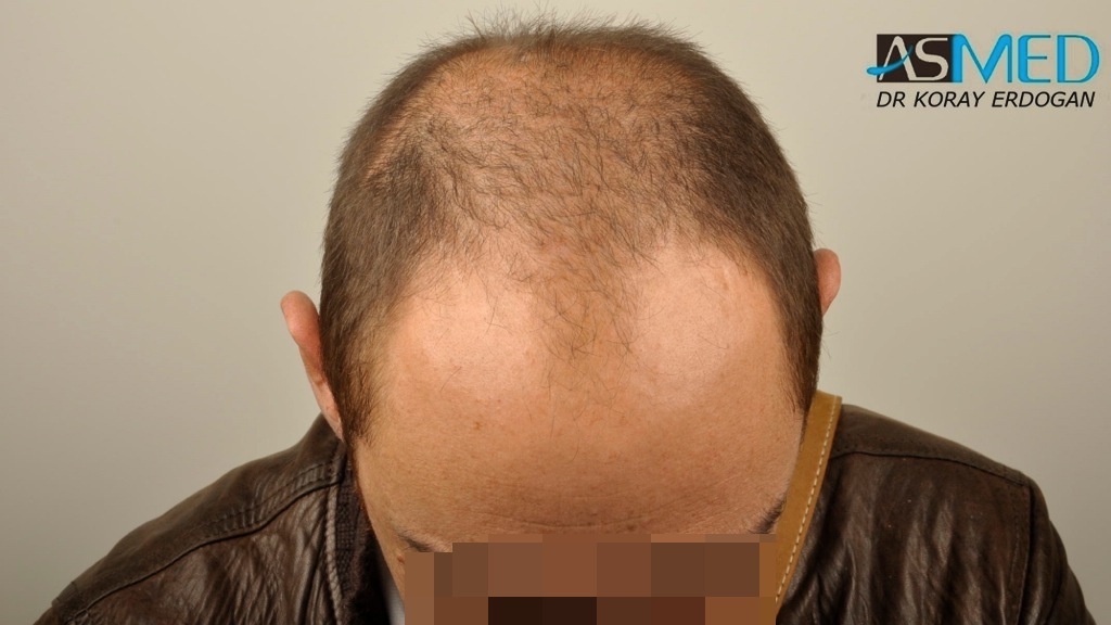 norwood4 4008-grafts-FUE file_zps5ce8927a