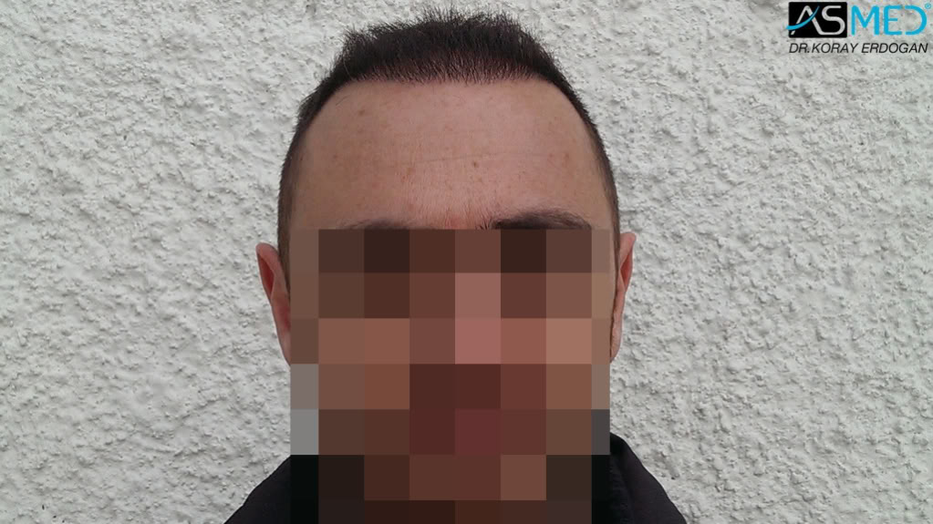 norwood4 4008-grafts-FUE file_zps637879aa