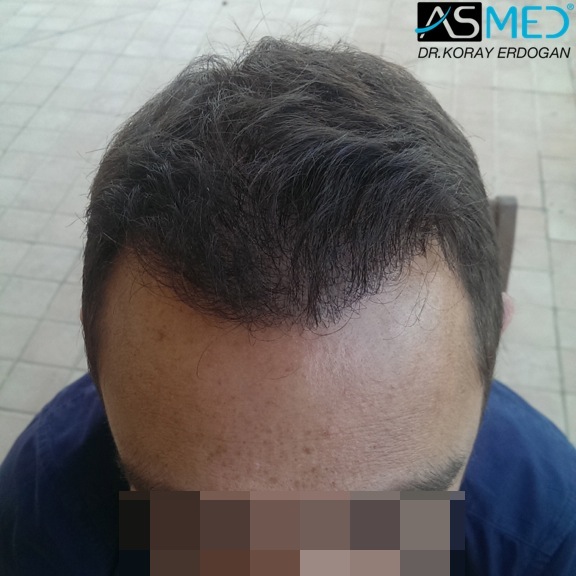 norwood4 4008-grafts-FUE file_zps68d1f3aa