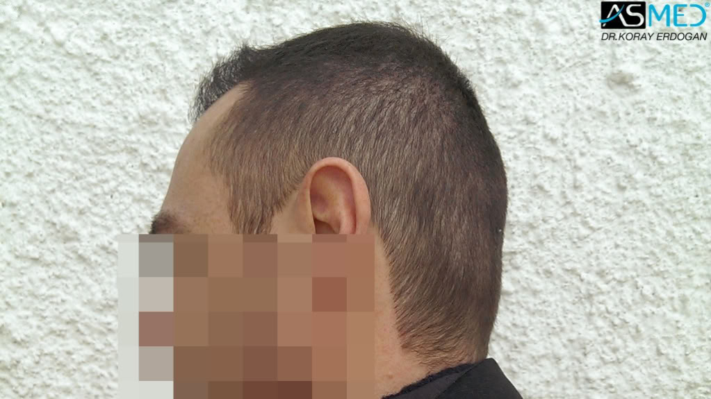 norwood4 4008-grafts-FUE file_zps6ac1de07