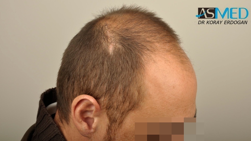 norwood4 4008-grafts-FUE file_zps718baa9b