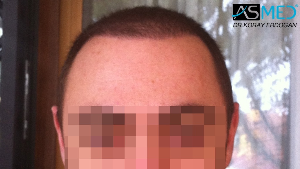 norwood4 4008-grafts-FUE file_zps71ee2ddf