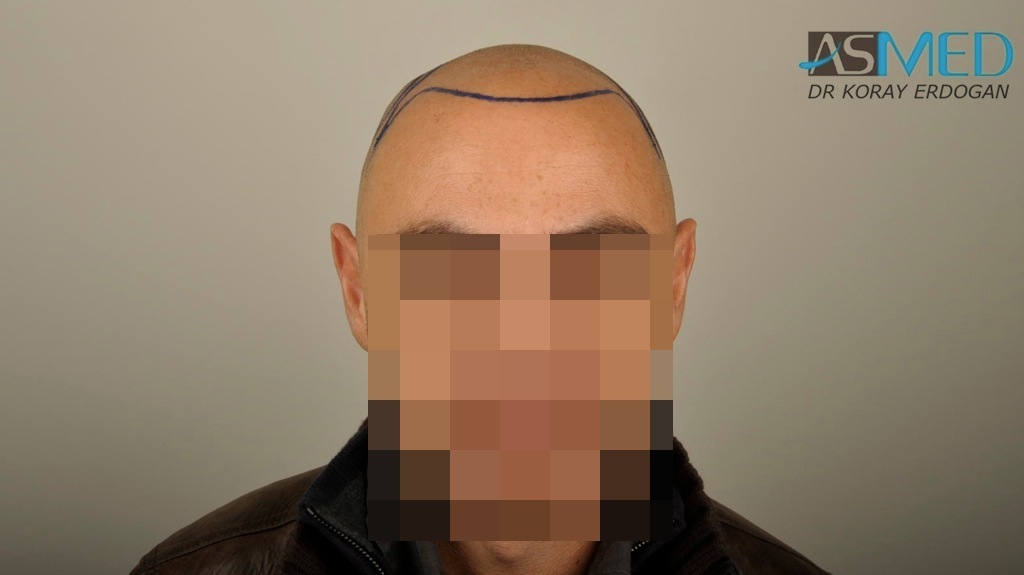 norwood4 4008-grafts-FUE file_zps8f7d0ded