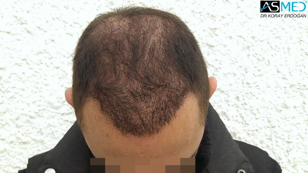 norwood4 4008-grafts-FUE file_zpsa3476469