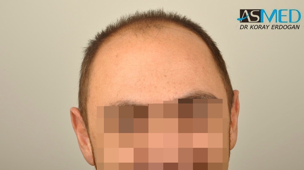 norwood4 4008-grafts-FUE file_zpsa9186b3e