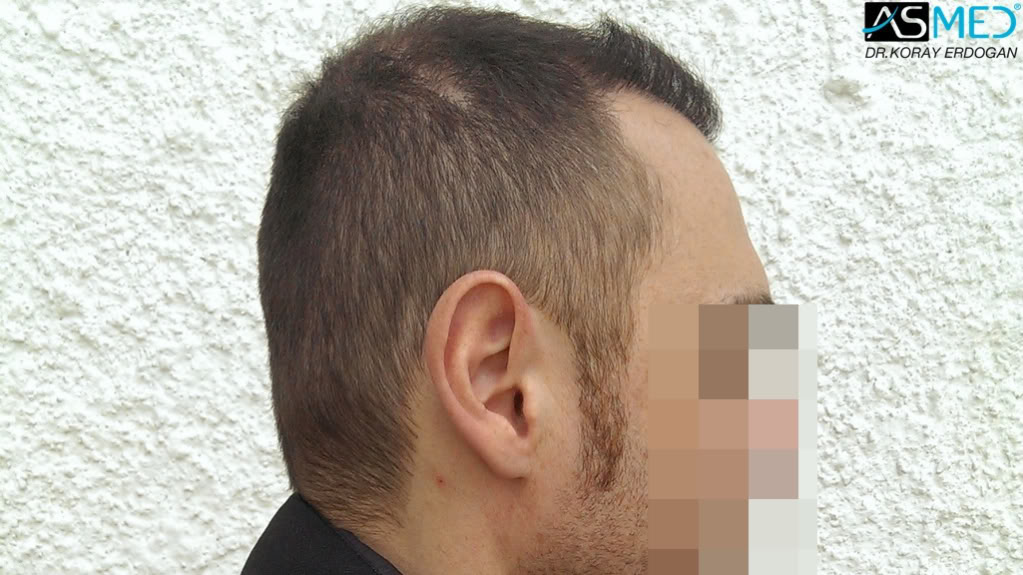 norwood4 4008-grafts-FUE file_zpsae003db9