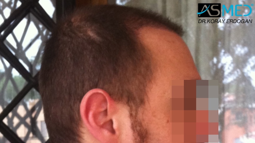 norwood4 4008-grafts-FUE file_zpsbddcc2c2