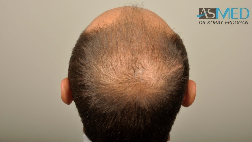 norwood4 4008-grafts-FUE file_zpsbdfe3de2