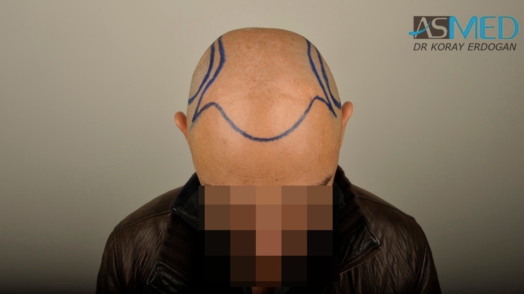 norwood4 4008-grafts-FUE file_zpsc4f9138b
