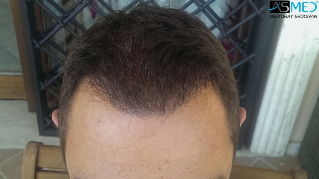 norwood4 4008-grafts-FUE file_zpsd0f9aac5