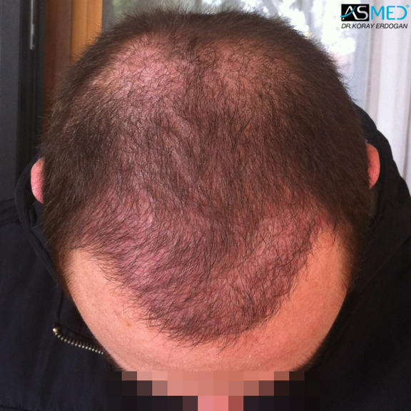 norwood4 4008-grafts-FUE file_zpsd7e06dcb
