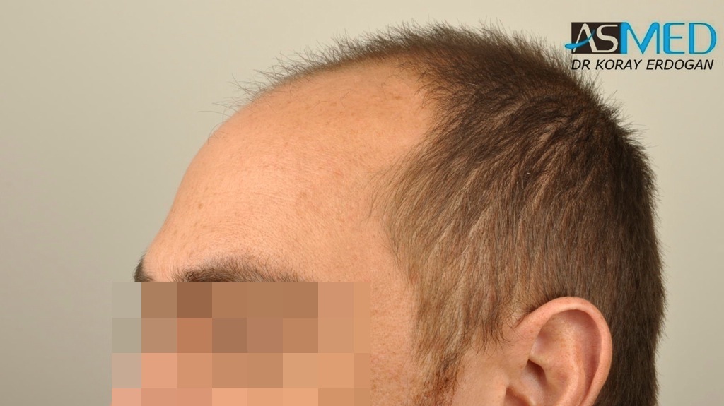 norwood4 4008-grafts-FUE file_zpsd91bf59e