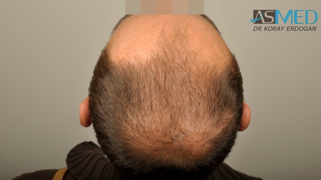 norwood4 4008-grafts-FUE file_zpsdfc8e6f0
