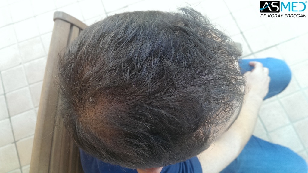 norwood4 4008-grafts-FUE file_zpse6ef450e