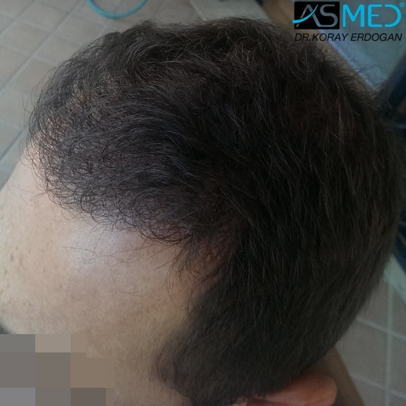 norwood4 4008-grafts-FUE file_zpsef064c2d