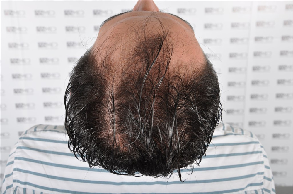 norwood4 4033-grafts-fue before _1