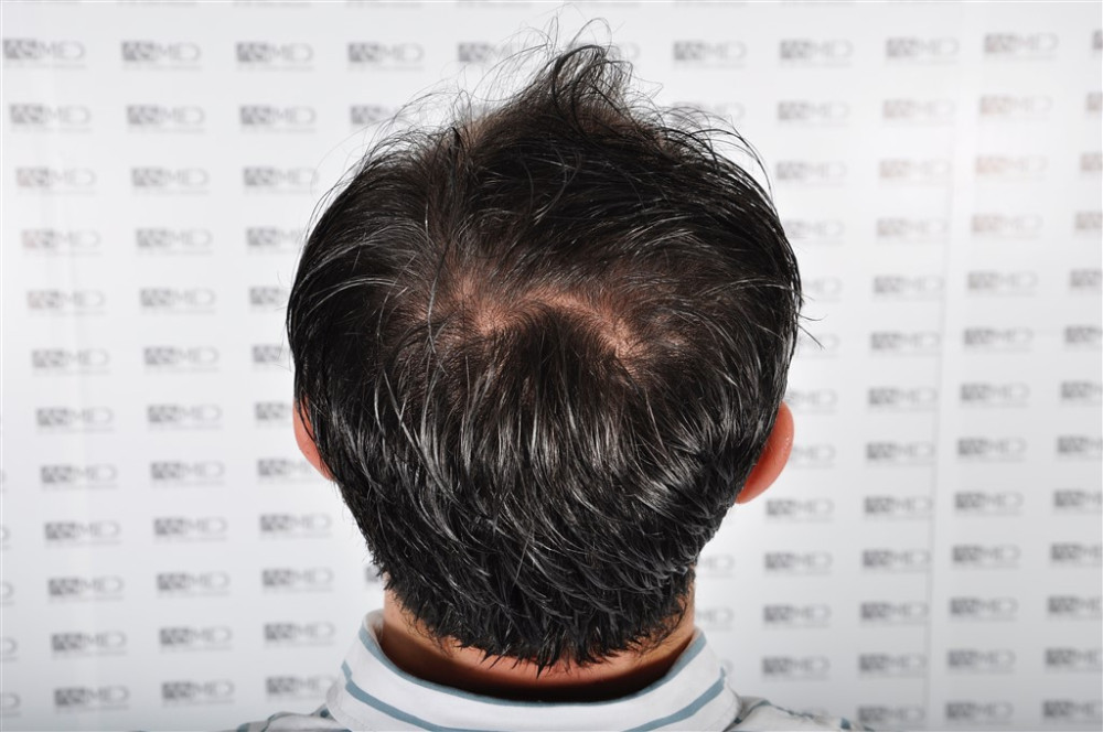 norwood4 4033-grafts-fue before _2