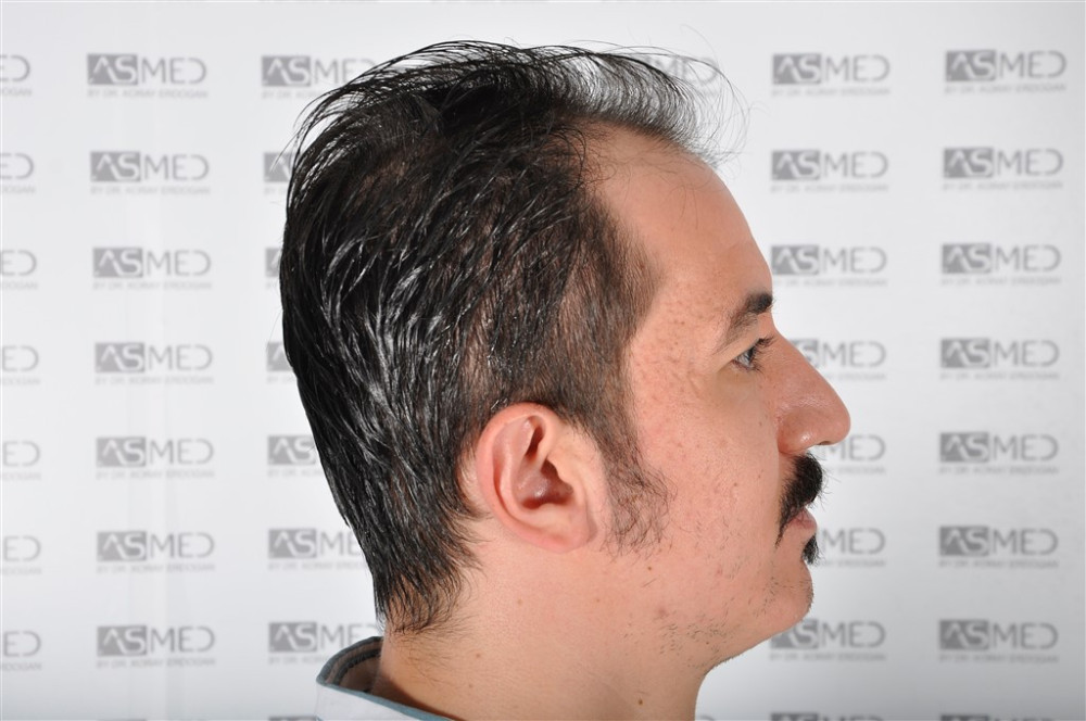 norwood4 4033-grafts-fue before _DSC0772