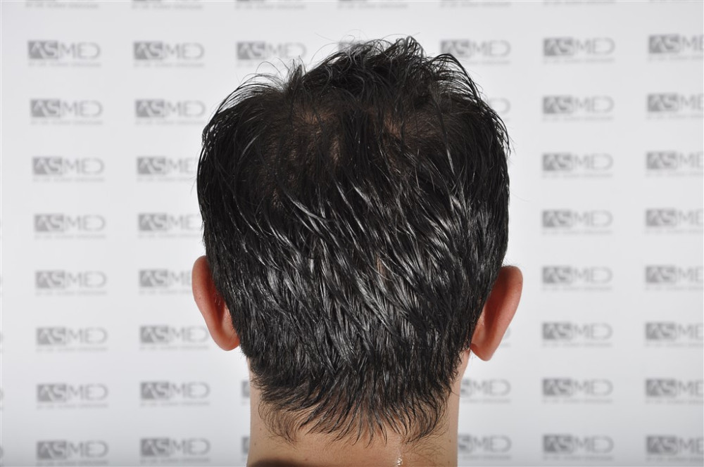 norwood4 4033-grafts-fue before _DSC0774