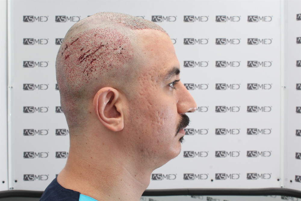 norwood4 4033-grafts-fue operation 16980_Sag
