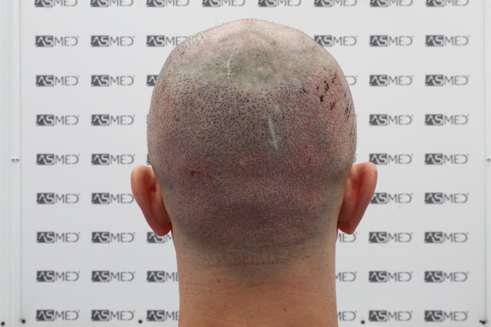 norwood4 4033-grafts-fue operation 16981_Arka