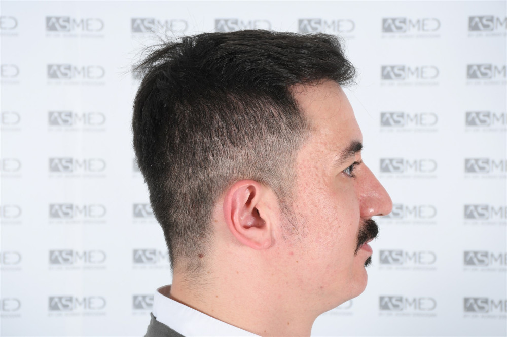 norwood4 4033-grafts-fue result DSC_2537