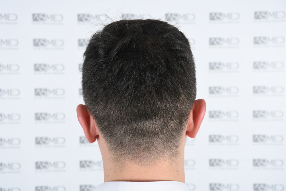 norwood4 4033-grafts-fue result DSC_2539