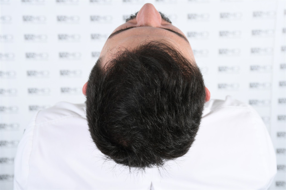 norwood4 4033-grafts-fue result DSC_2540