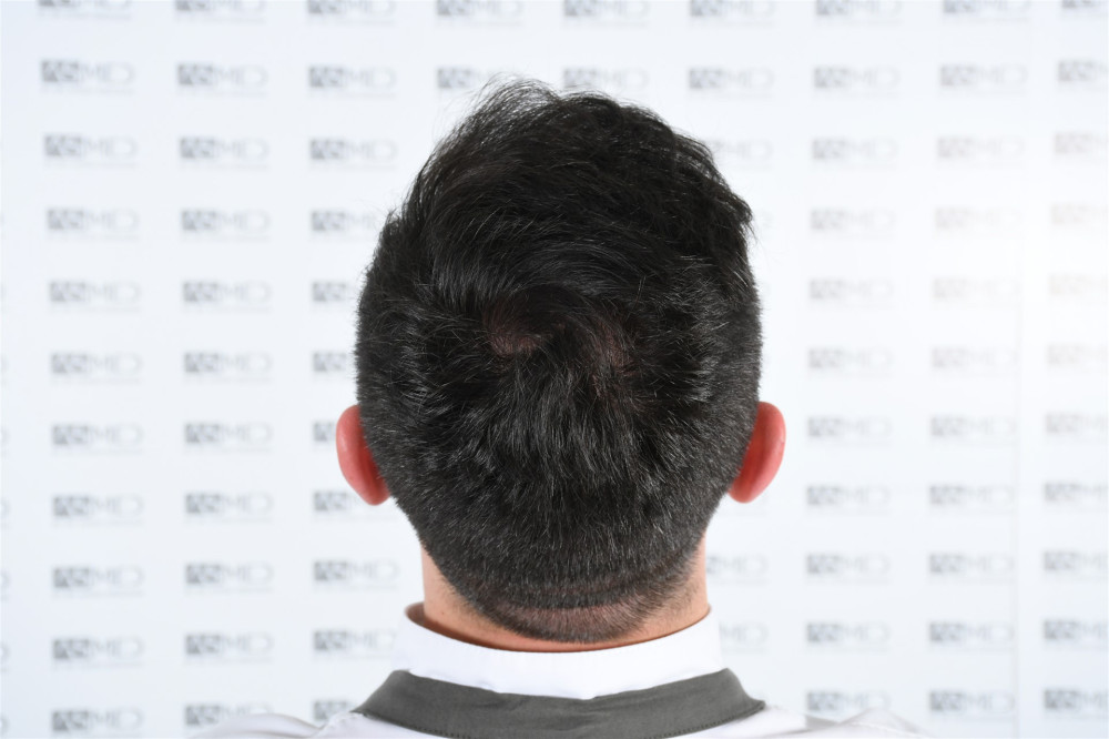norwood4 4033-grafts-fue result DSC_2541