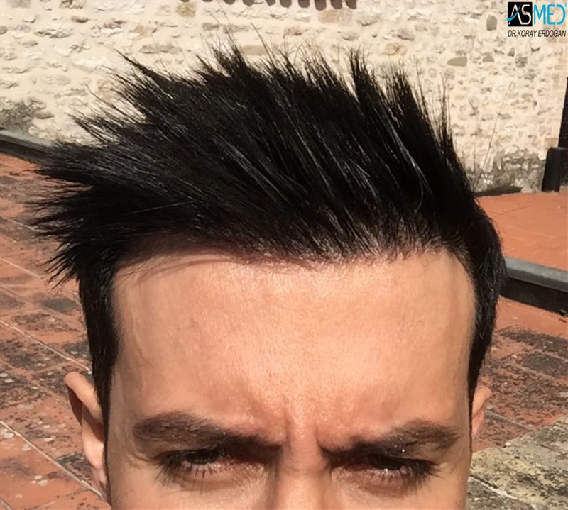 norwood4 4205-grafts-FUE 1year5months V2_1aaa