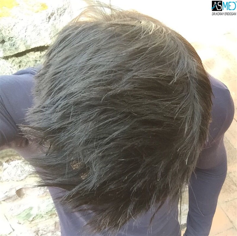 norwood4 4205-grafts-FUE 1year5months V2_2aaa