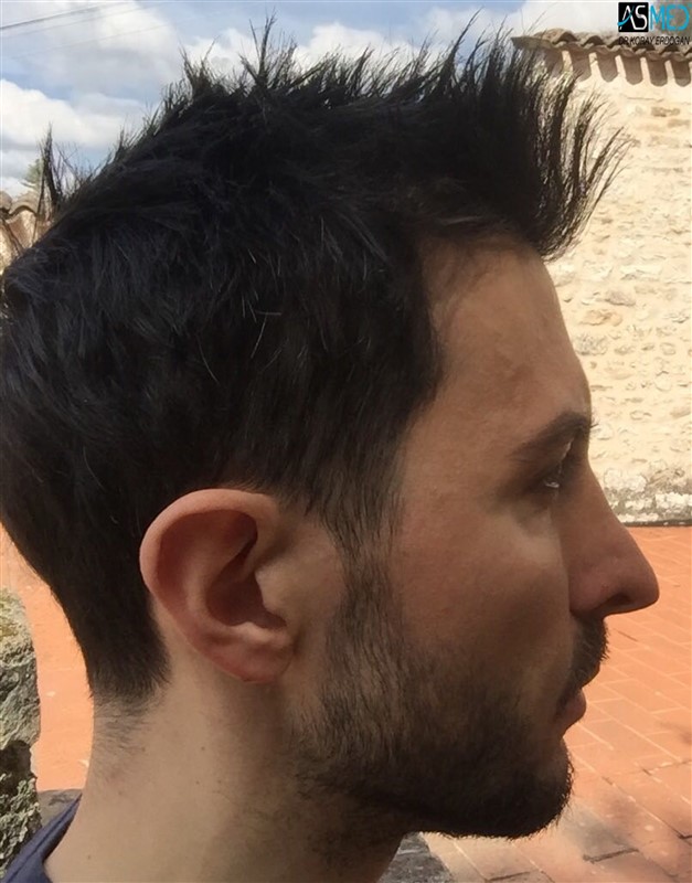 norwood4 4205-grafts-FUE 1year5months V2_3aaa