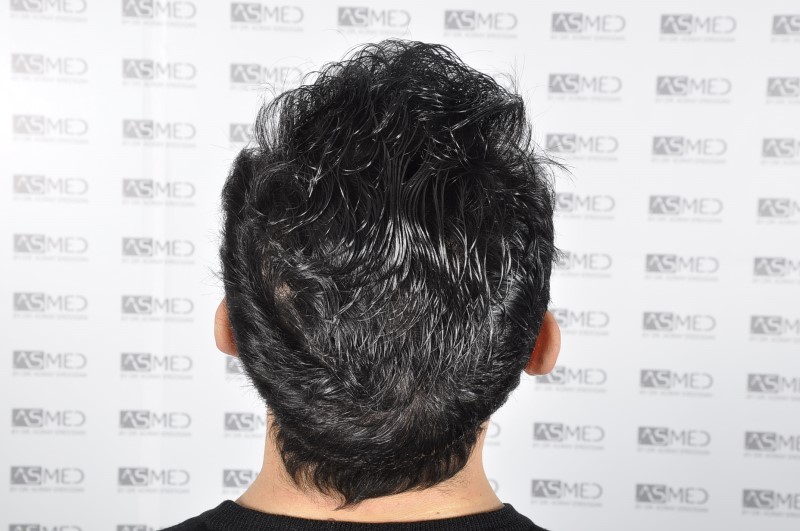 norwood4 4205-grafts-FUE 3year5months 10
